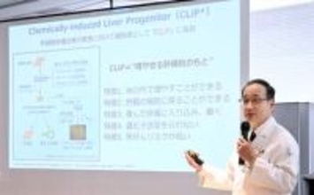 肝硬変の新治療法へ世界初の臨床研究　長崎大病院など、5～10年後の実用化目指す