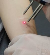 『消えるタトゥー』「最高にかわいい」と流行の裏でSNS上に〝不安の声〟も…　「正しい知識をもって」と専門家も警鐘