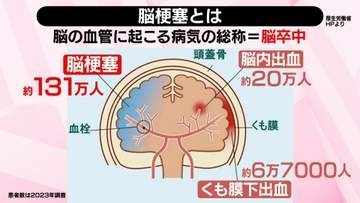 【解説】「脳梗塞」なりやすい人は？　サンドウィッチマンの伊達みきおさんが休養……注意すべき症状、予防策は【 #みんなのギモン 】