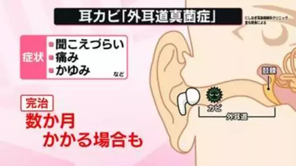 【注意】イヤホン長時間使用で「耳カビ」リスク増　専門家が警鐘、治癒に数か月かかることも