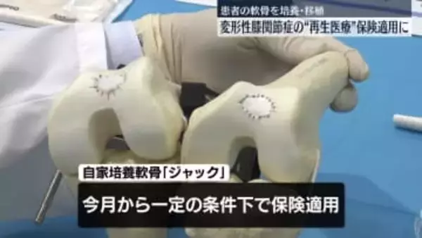 変形性膝関節症の“再生医療製品”保険適用に　医療現場への本格的導入目指す
