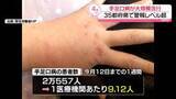 「「手足口病」の患者数　35都府県で警報レベル超え　2年ぶりの大規模流行」の画像1