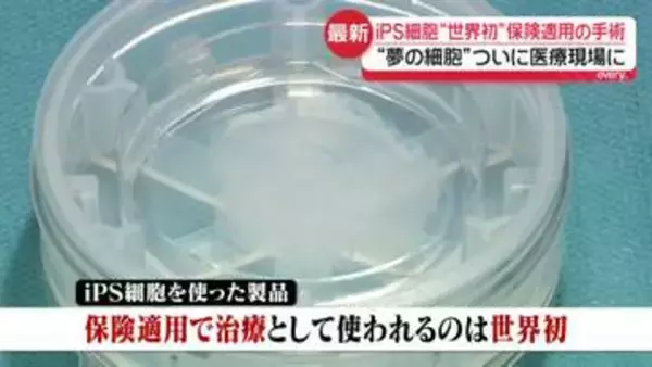 iPS細胞“世界初”保険適用の手術　“夢の細胞”ついに医療現場に　iPS細胞の実用化…今後は？