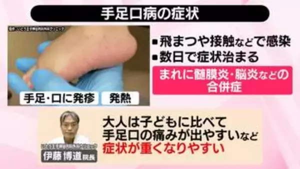 全国で手足口病が大流行、東京は2年ぶりの警報レベル　島根では1医療機関あたり1週間で20人超の患者数に【#みんなのギモン】