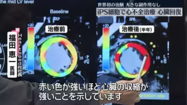 iPS細胞で心不全治療　心臓の機能が回復　大きな副作用なし…世界初の治験