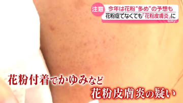 都内でもスギ花粉飛散開始…花粉症でなくても“花粉皮膚炎”のおそれ　今年は飛散量多めの予想も