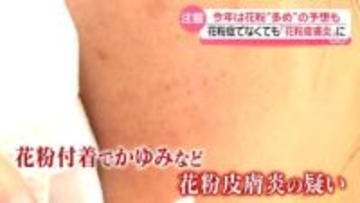 都内でもスギ花粉飛散開始…花粉症でなくても“花粉皮膚炎”のおそれ　今年は飛散量多めの予想も