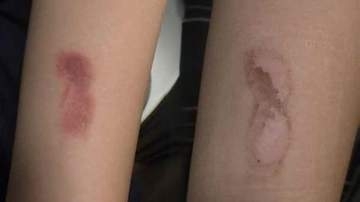 その使い方大丈夫？冷却グッズの使用で皮膚トラブル急増　保冷剤で「凍傷」も…医師が指摘する落とし穴とは