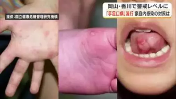 大人も注意！全国的に流行「手足口病」岡山・香川でも警報レベル上回る　夏休み中の家庭内予防を医師に聞く