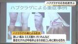 「ハブクラゲの応急処置学ぶ　マリンレジャーシーズンに講習会」の画像1