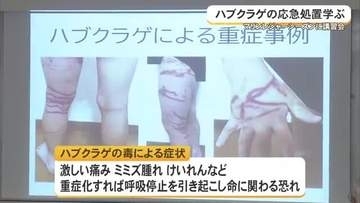 ハブクラゲの応急処置学ぶ　マリンレジャーシーズンに講習会