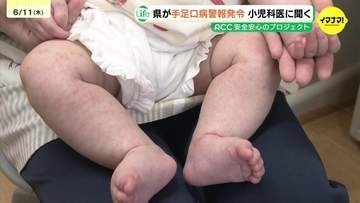 かかっても軽く済むためには･･･？　「手足口病」　広島県が「警報」発令　1･2歳児さんは要注意！
