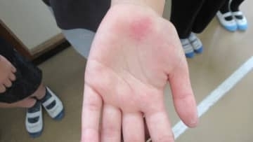 【2025年ニュースPV数8位】プール授業で児童25人が”手に湿疹としびれ”"腹痛"　手の症状は「プールサイドのマットによる圧迫痕」、 腹痛については「個人の体調や体が冷えたことによるもの」北九州市教委が最終判断　救急要請の判断は「妥当だった」