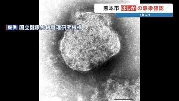 【はしか】熊本市で7年ぶりの感染者、県外からの転居後に発症　全国では急増525人で去年の2倍近くに
