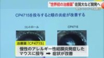 世界初“分子治療薬”開発へ 慢性のアレルギー性結膜炎の原因解明に取り組む【佐賀県】