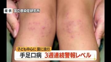 3週連続の警報レベル・手足口病の患者数391人　ひまつ・便から感染…こまめな手洗いを　山形