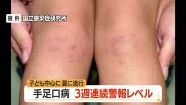 3週連続の警報レベル・手足口病の患者数391人　ひまつ・便から感染…こまめな手洗いを　山形