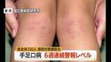 「6週連続警報レベル・手足口病患者数130人（前週比+15人）　タオル共用避けこまめに手洗いを　山形」の画像1