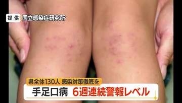 6週連続警報レベル・手足口病患者数130人（前週比+15人）　タオル共用避けこまめに手洗いを　山形