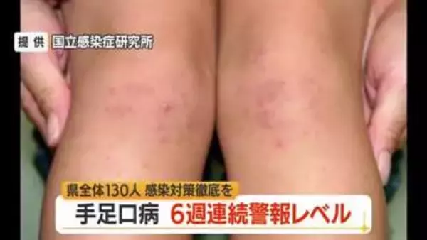 6週連続警報レベル・手足口病患者数130人（前週比+15人）　タオル共用避けこまめに手洗いを　山形