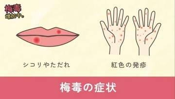 梅毒の早期発見へ啓発動画　岡山市、若者の感染増加で