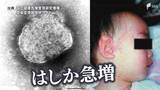 「国内で急増の「はしか」感染するとどうなる？ 感染力はコロナの5倍 唯一の対抗策は「ワクチン接種」=静岡」の画像1