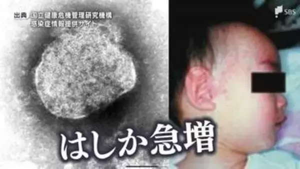 国内で急増の「はしか」感染するとどうなる？ 感染力はコロナの5倍 唯一の対抗策は「ワクチン接種」=静岡