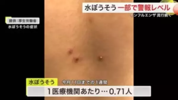 「水ぼうそう」仙南で警報レベル　１医療機関あたり４人　インフルも高水準〈宮城〉