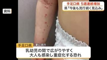 宮城県内の手足口病患者数が５週連続で増加　大流行したおととしと似た傾向　県が感染対策の徹底呼びかけ
