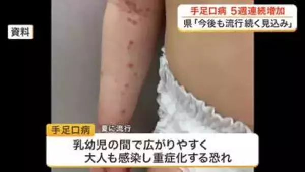 宮城県内の手足口病患者数が５週連続で増加　大流行したおととしと似た傾向　県が感染対策の徹底呼びかけ