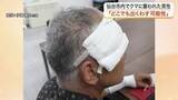 「「クマだと思った瞬間、倒された」仙台市で今年初の人身被害　顔や手に傷痕残る男性が当時の恐怖を語る」の画像1