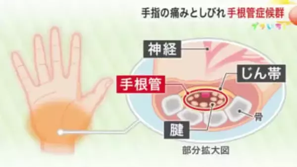 指の先のしびれや痛み「手根管症候群」かも　長時間のデスクワークなど原因　予防する座り方やセルフケアも