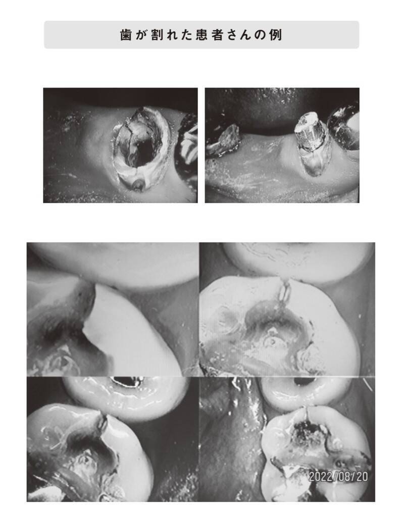 大切な歯を失ってしまうかもしれない“ブラキシズム”とは？ 「原因不明の偏頭痛」「犬歯の尖りがなくなった」「歯の付け根にくぼみ」の兆候には要注意