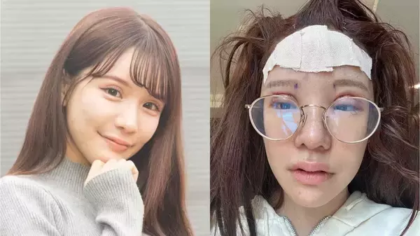 「最も高額だったのはアゴで437万円」整形総額2400万円の人気インフルエンサーが明かす最もしんどかった３つの手術「血を吐き続け、息もしづらくて…」