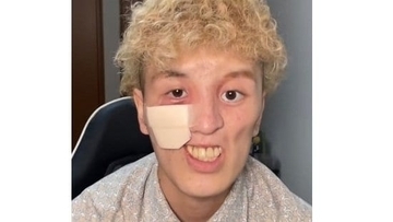 顔に穴が空き、日に日に大きく…希少がんと闘う青年の胸の内、気丈に笑う彼の人生観「僕の人生は僕だけが送っているもの」