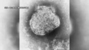 高知県内4例目　はしかの患者確認