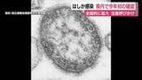「静岡県内で今年初の“はしか”感染を確認　全国的に拡大傾向にあり注意呼びかけ」の画像1