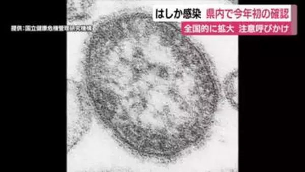 静岡県内で今年初の“はしか”感染を確認　全国的に拡大傾向にあり注意呼びかけ