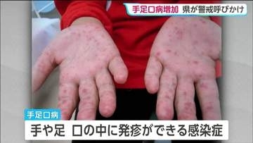 宮城県内の手足口病感染者数　定点医療機関1か所あたり8.29人と前の週より増加　先週から引き続き警報レベル