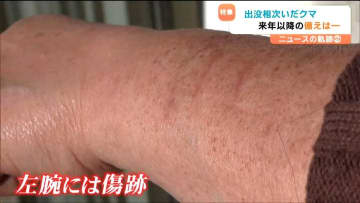 「熊と聞くだけで恐怖」左腕に残る引っかき傷 襲われた女性が語る後遺症「破傷風の注射、安定剤も飲んでいる」次の大量出没は2年後？