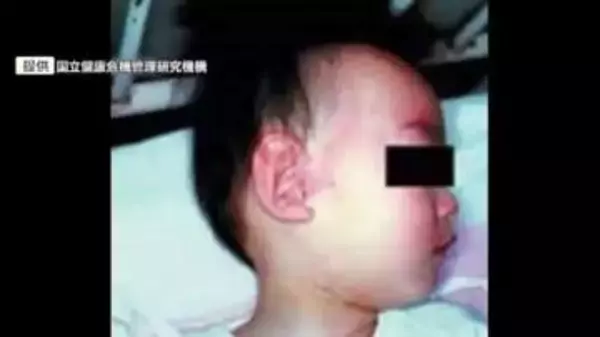 「ワクチン接種歴2回あるのに感染か　福岡県内で今年3人目の「はしか」患者　海外渡航歴なしの20代女性」の画像