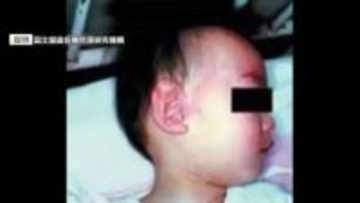 ワクチン接種歴2回あるのに感染か　福岡県内で今年3人目の「はしか」患者　海外渡航歴なしの20代女性