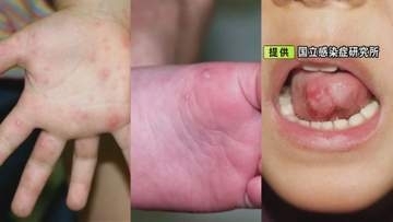 ワクチンや治療薬なく…子供を中心に流行中の『手足口病』症状が収まった後もウイルスの排泄続き大人も注意