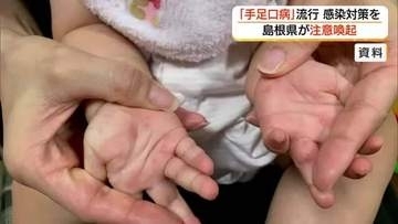「手足口病」島根県で流行…患者報告数が警報基準を超過　手洗いなど感染対策徹底を呼びかけ