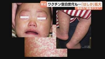 はしか感染拡大…子どもだけじゃない！ワクチン空白世代は注意　症状が軽く気付きにくい「修飾麻疹」も