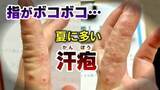 「気がつくと指がボコボコに…1本の指に数十個の“水ぶくれ” 夏に増える「汗疱(かんぽう）」とは？ 水虫との違いや予防策を医師が解説」の画像1