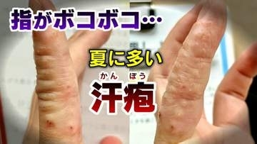 気がつくと指がボコボコに…1本の指に数十個の“水ぶくれ” 夏に増える「汗疱(かんぽう）」とは？ 水虫との違いや予防策を医師が解説