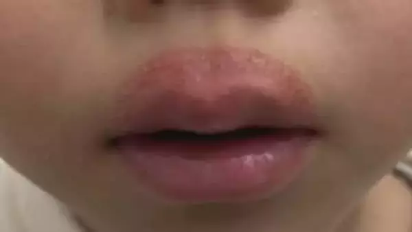 「なめまわし皮膚炎」ガサガサ唇なめないで！冬に増える乾燥トラブル　幼児や小学生なりやすい？