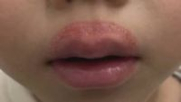 「なめまわし皮膚炎」ガサガサ唇なめないで！冬に増える乾燥トラブル　幼児や小学生なりやすい？