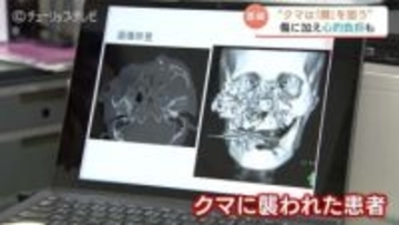 “軽傷であっても命に関わる可能性”医師が語るクマ被害の実態  顔面骨折と破傷風の脅威 遭遇時は“顔と頭を守る”